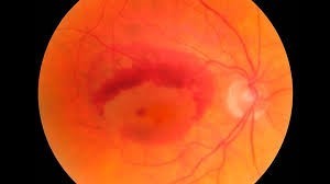 Malattia della macula gialla e alimentazione