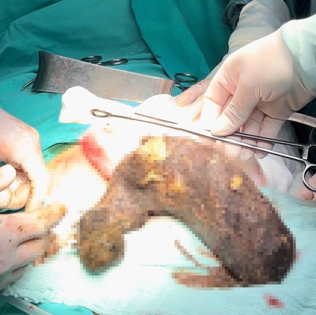 A young girl with a hair-eating habit for 15 years had a 2-kilogram hairball removed from her stomach.